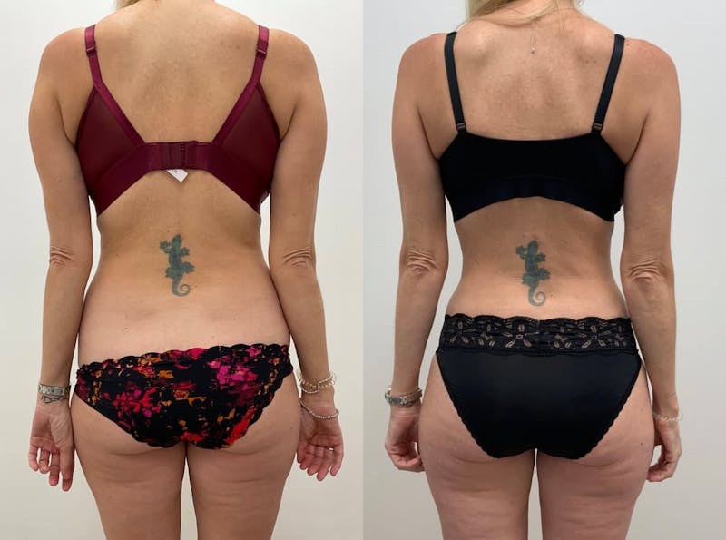 Tummy Tuck Before & After Gallery - Patient 302020 - Image 1
