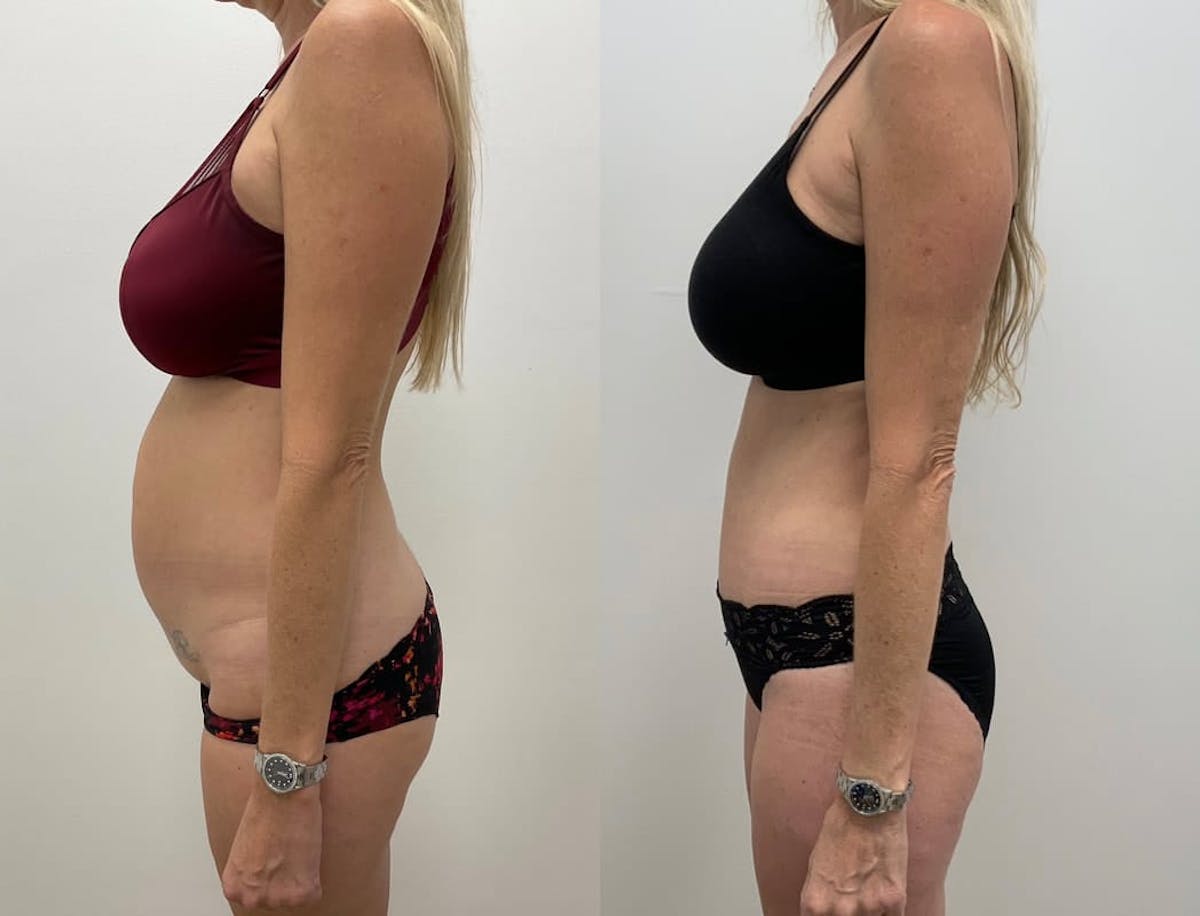 Tummy Tuck Before & After Gallery - Patient 302020 - Image 2
