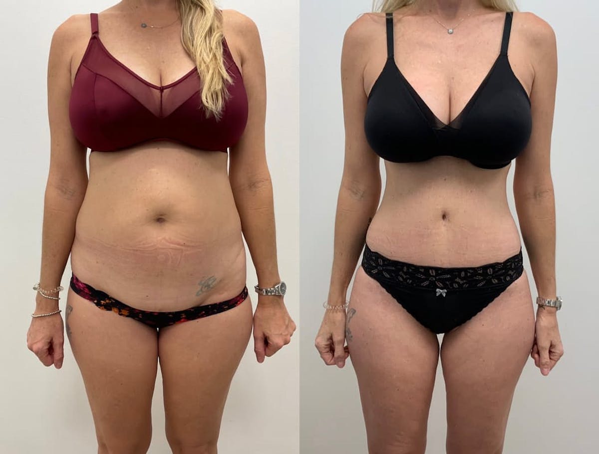 Tummy Tuck Before & After Gallery - Patient 302020 - Image 3