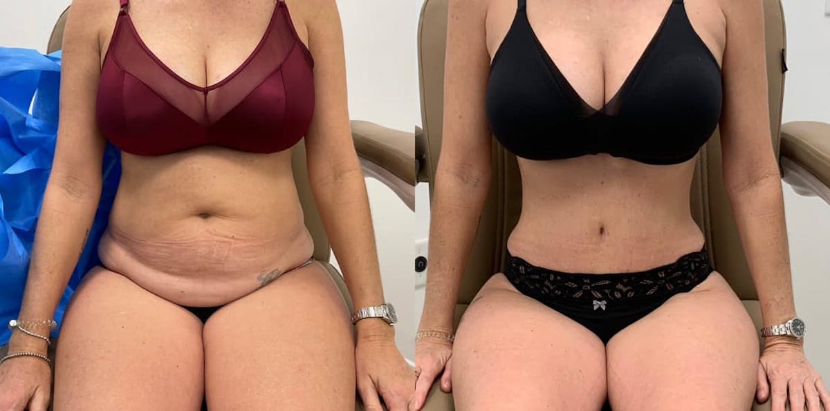 Tummy Tuck Before & After Gallery - Patient 302020 - Image 4