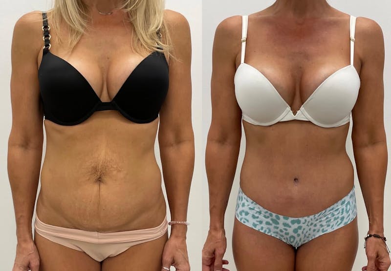 Tummy Tuck Before & After Gallery - Patient 118173 - Image 1
