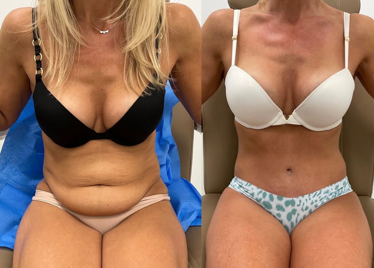 Tummy Tuck Before & After Gallery - Patient 118173 - Image 2