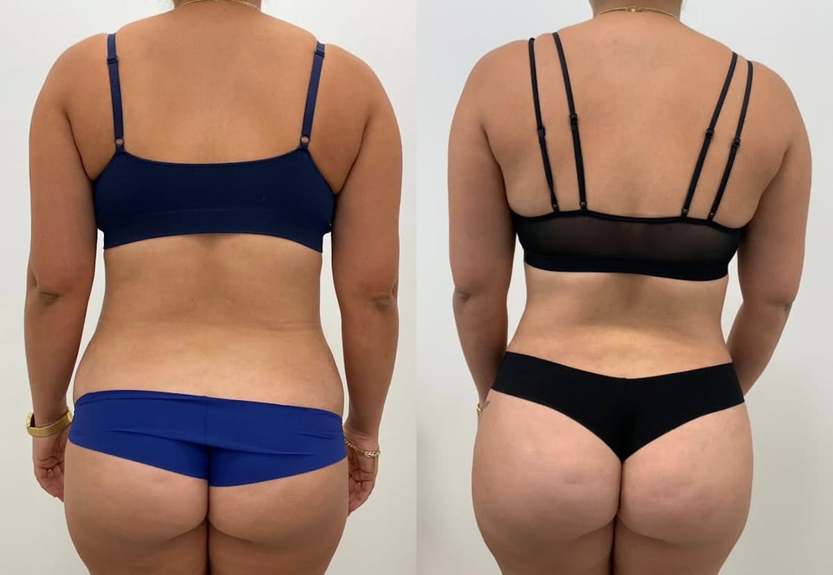 Tummy Tuck Before & After Gallery - Patient 271524 - Image 1