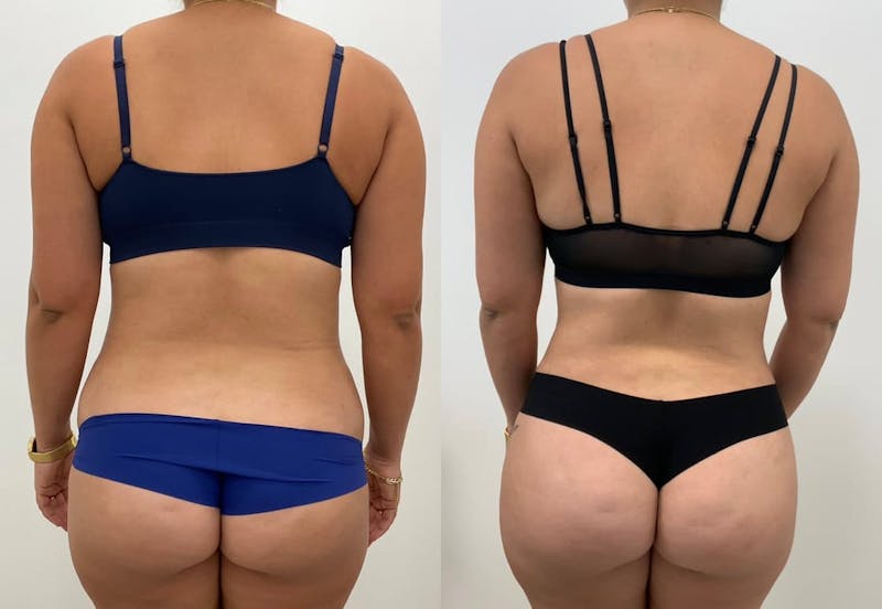 Tummy Tuck Before & After Gallery - Patient 271524 - Image 1