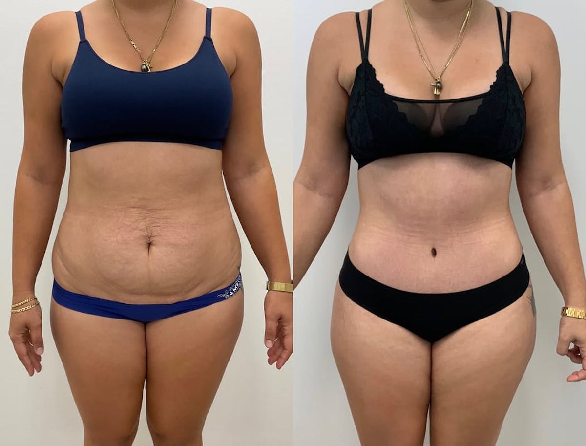 Tummy Tuck Before & After Gallery - Patient 271524 - Image 2