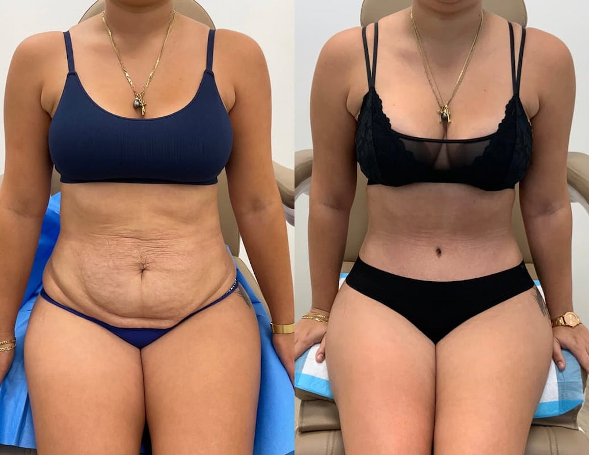 Tummy Tuck Before & After Gallery - Patient 271524 - Image 3