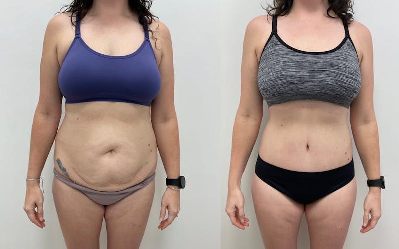 Tummy Tuck Before & After Gallery - Patient 878129 - Image 1