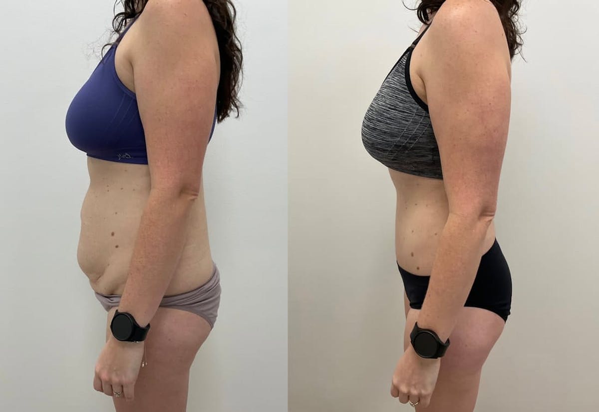 Tummy Tuck Before & After Gallery - Patient 878129 - Image 2