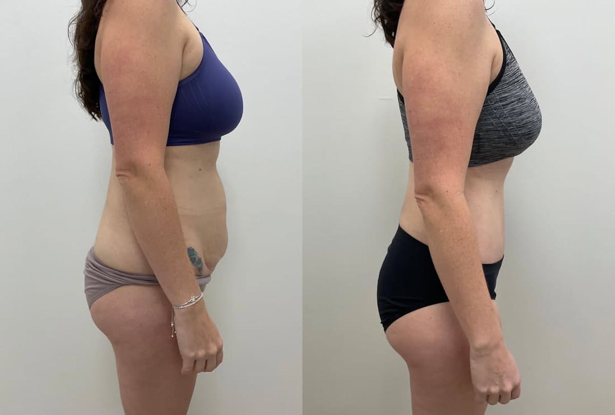 Tummy Tuck Before & After Gallery - Patient 878129 - Image 3
