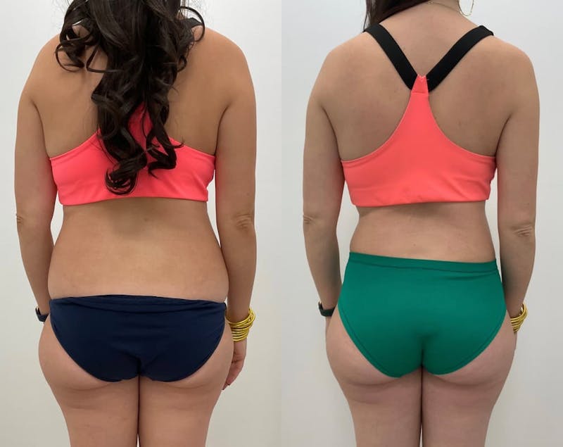 Tummy Tuck Before & After Gallery - Patient 897602 - Image 1