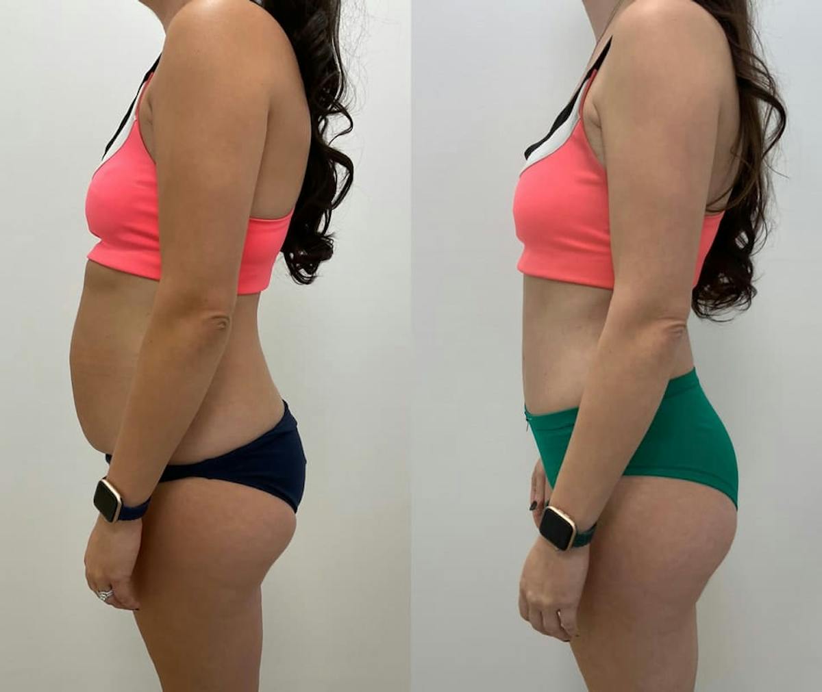 Tummy Tuck Before & After Gallery - Patient 897602 - Image 2
