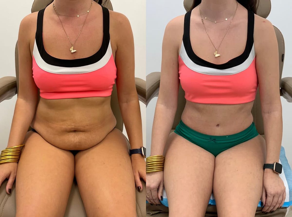 Tummy Tuck Before & After Gallery - Patient 897602 - Image 4