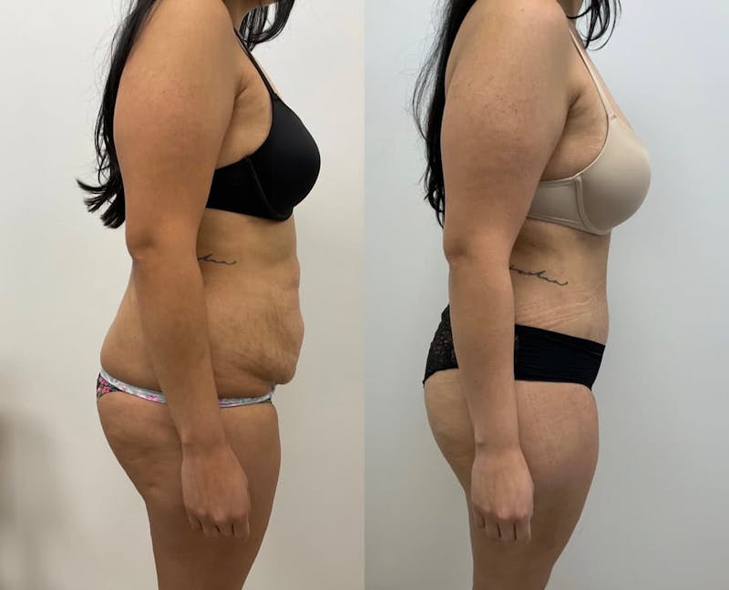 Tummy Tuck Before & After Gallery - Patient 288676 - Image 1