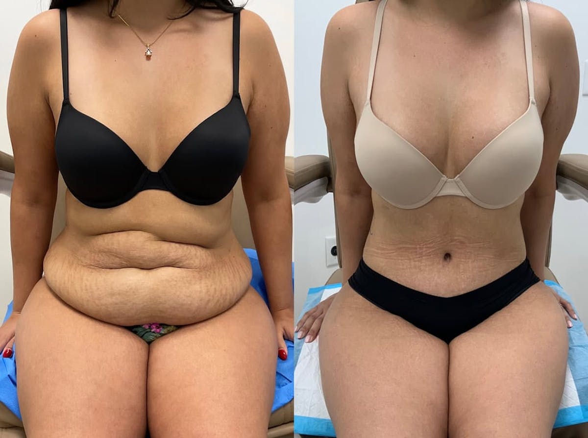 Tummy Tuck Before & After Gallery - Patient 288676 - Image 2