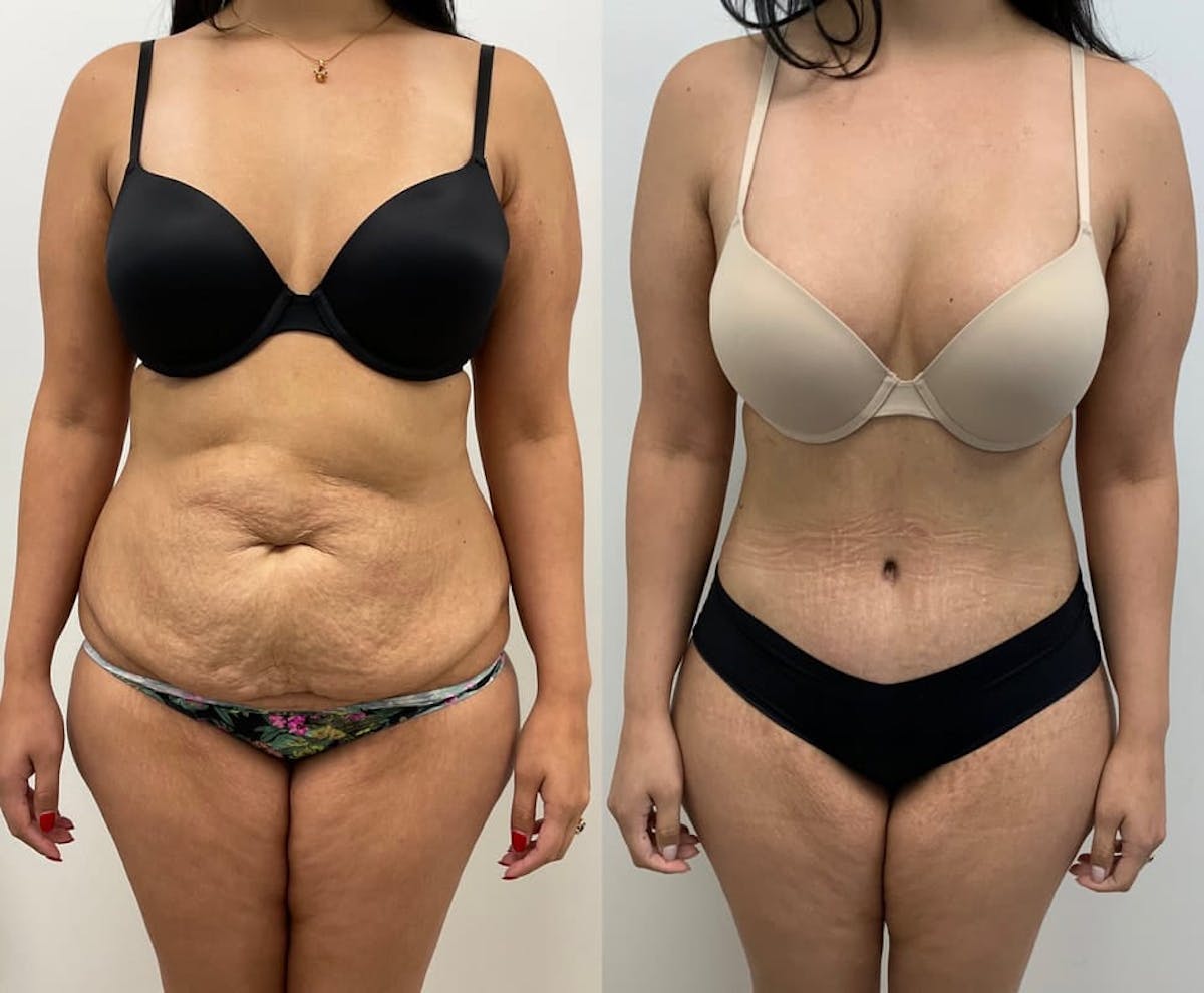 Tummy Tuck Before & After Gallery - Patient 288676 - Image 3