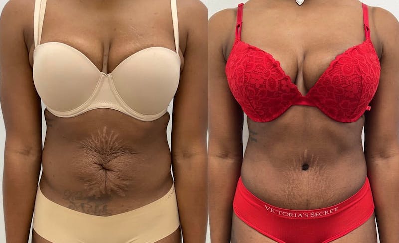 Tummy Tuck Before & After Gallery - Patient 909789 - Image 1