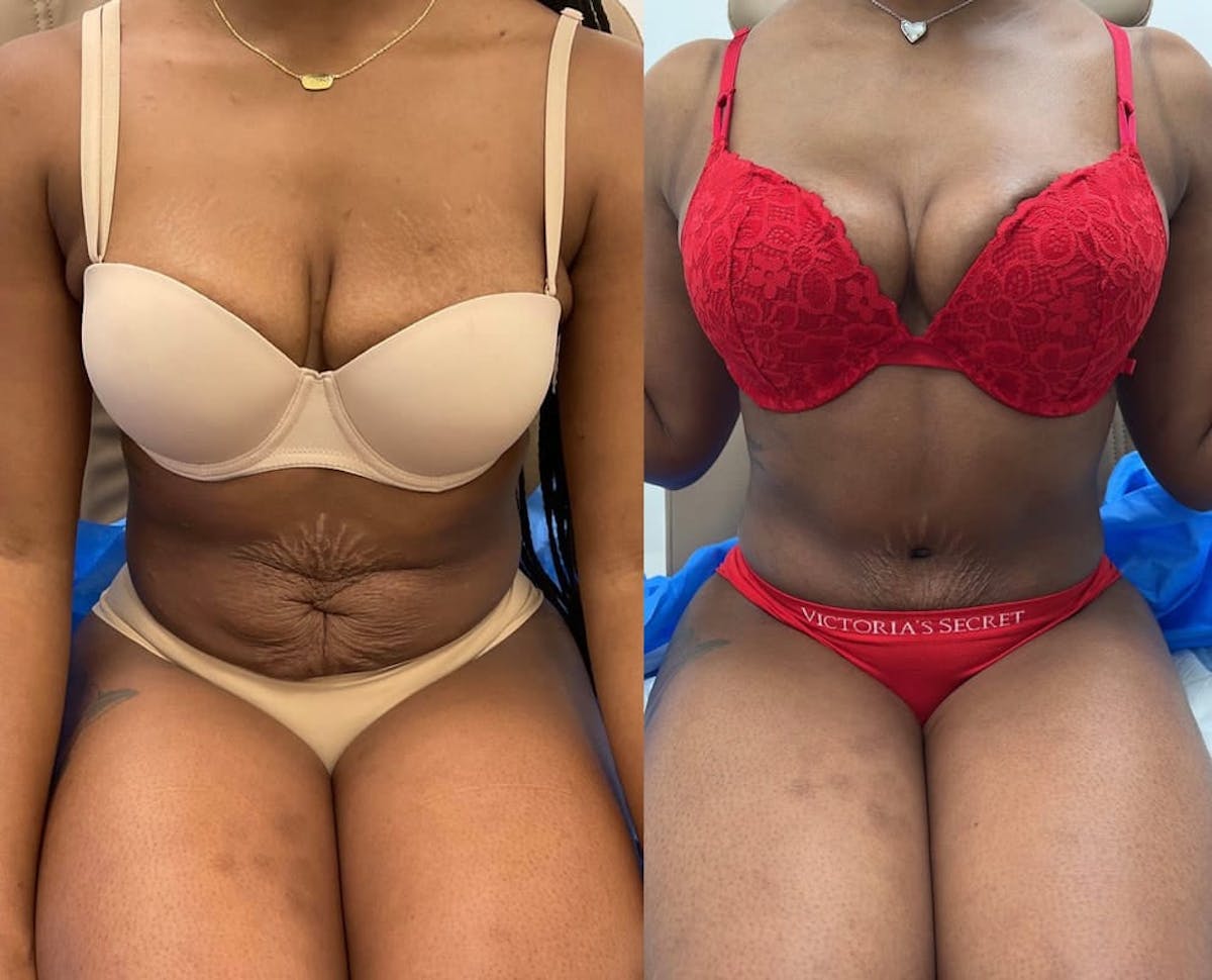Tummy Tuck Before & After Gallery - Patient 909789 - Image 2
