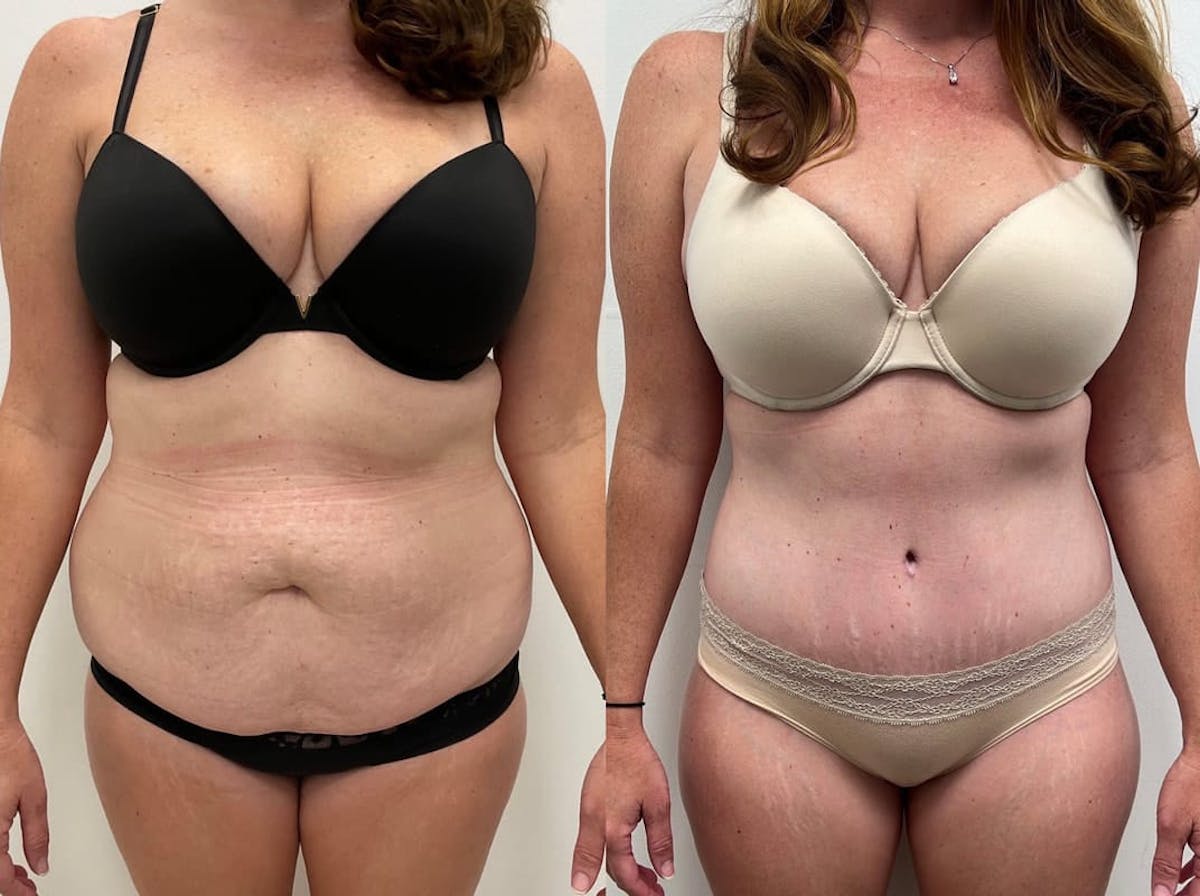 Tummy Tuck Before & After Gallery - Patient 246394 - Image 1