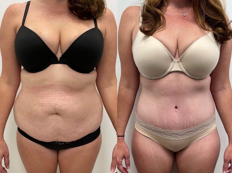 Tummy Tuck Before & After Gallery - Patient 246394 - Image 1