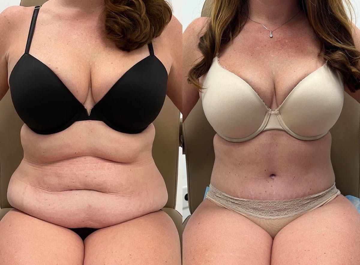 Tummy Tuck Before & After Gallery - Patient 246394 - Image 2
