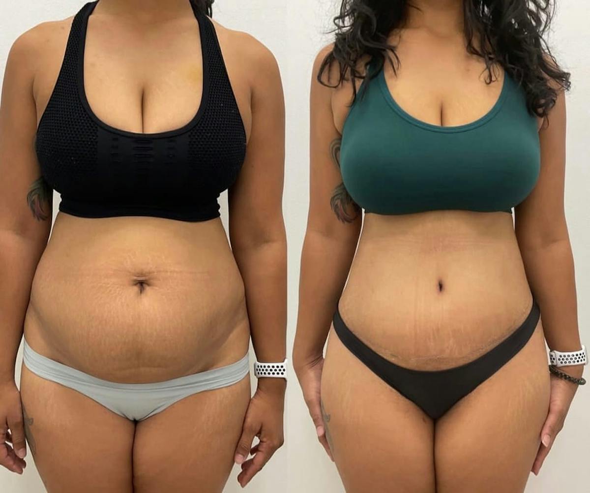 Tummy Tuck Before & After Gallery - Patient 129081 - Image 1