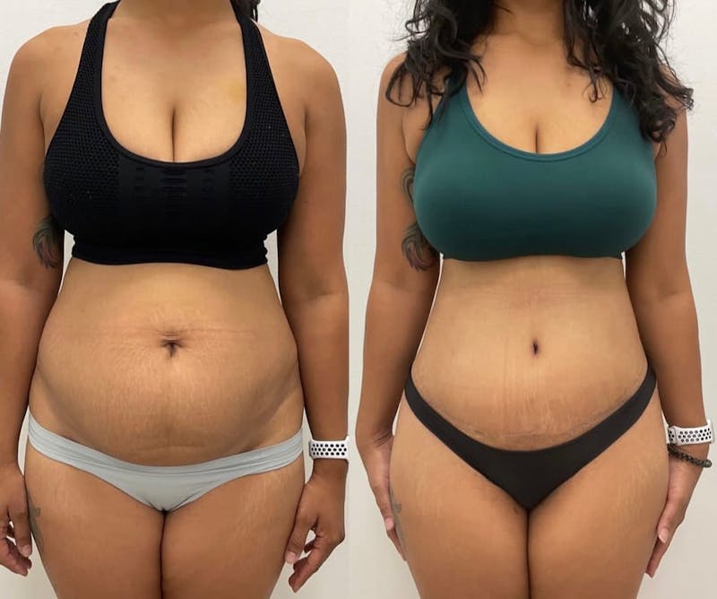 Tummy Tuck Before & After Gallery - Patient 129081 - Image 1