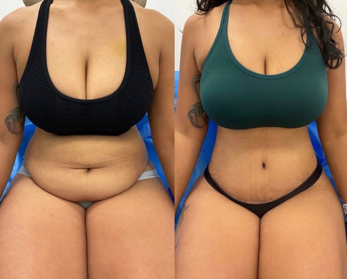 Tummy Tuck Before & After Gallery - Patient 129081 - Image 2