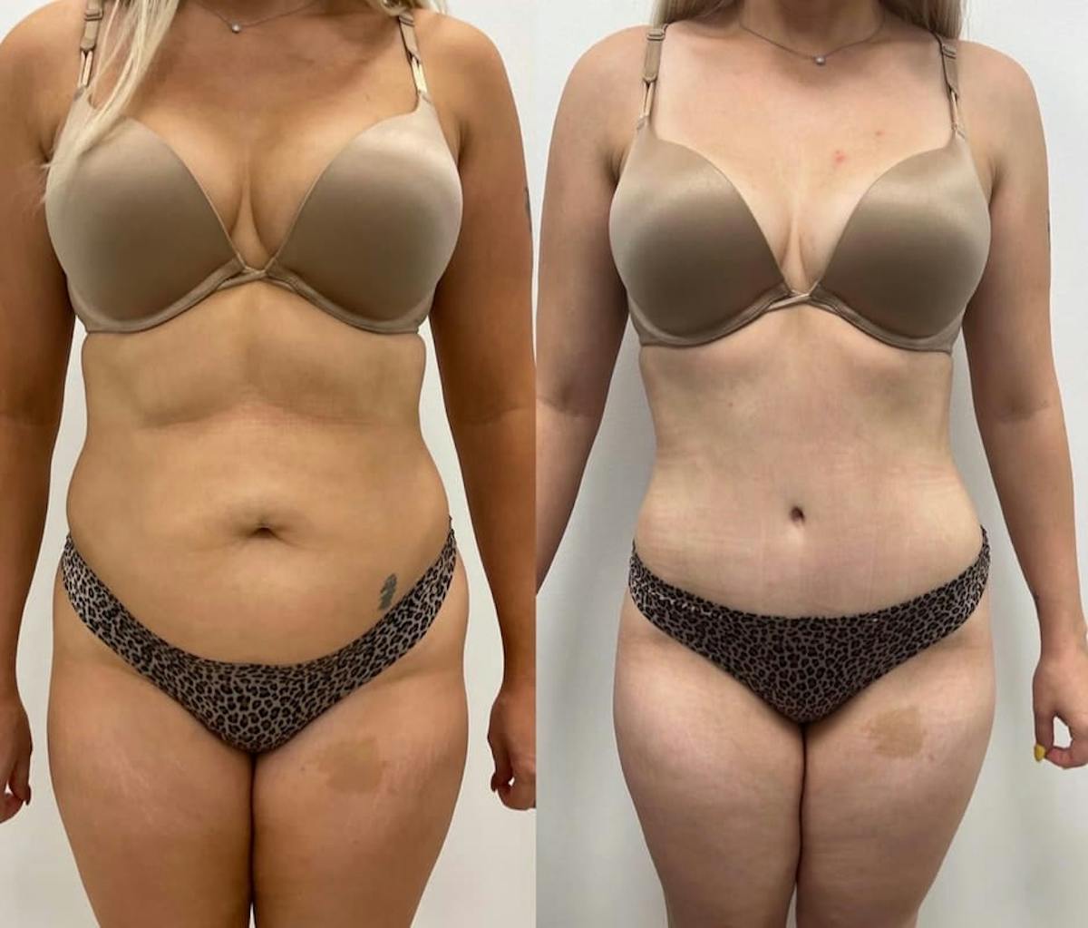 Tummy Tuck Before & After Gallery - Patient 213012 - Image 1