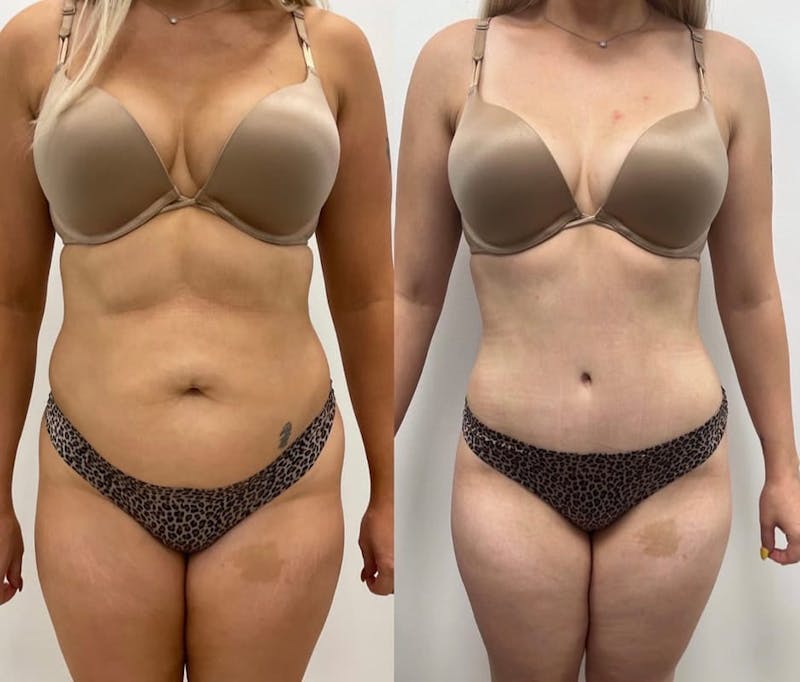 Tummy Tuck Before & After Gallery - Patient 213012 - Image 1