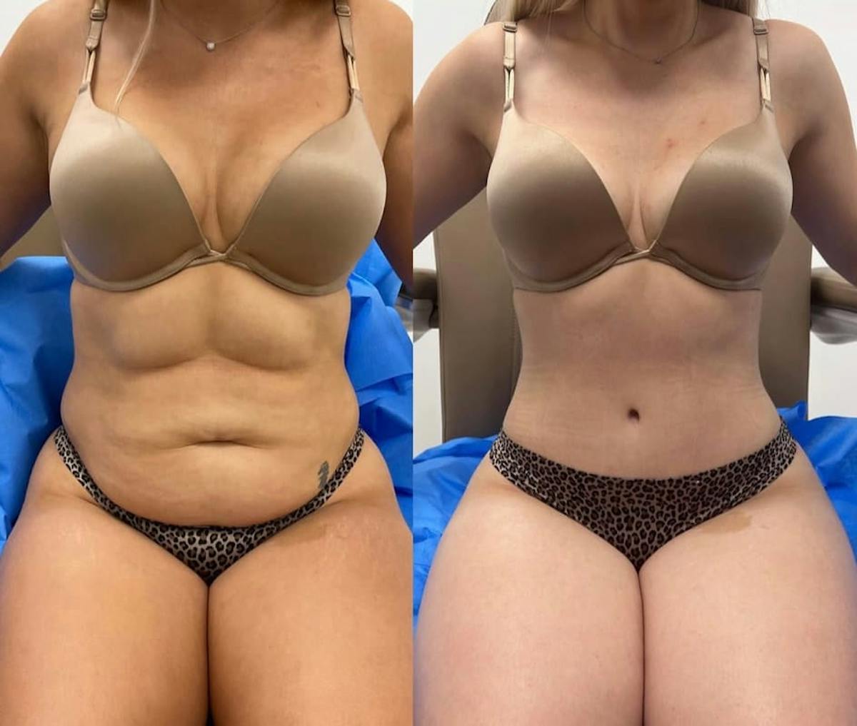 Tummy Tuck Before & After Gallery - Patient 213012 - Image 2