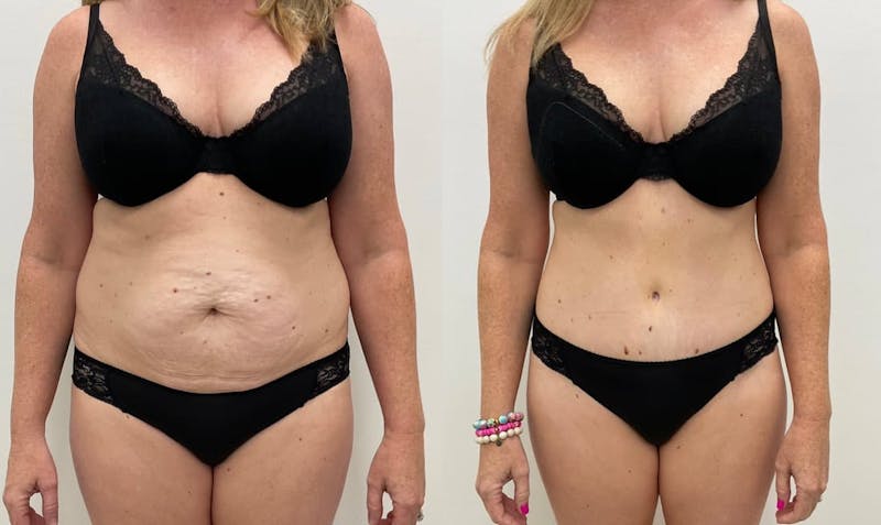 Tummy Tuck Before & After Gallery - Patient 235340 - Image 1