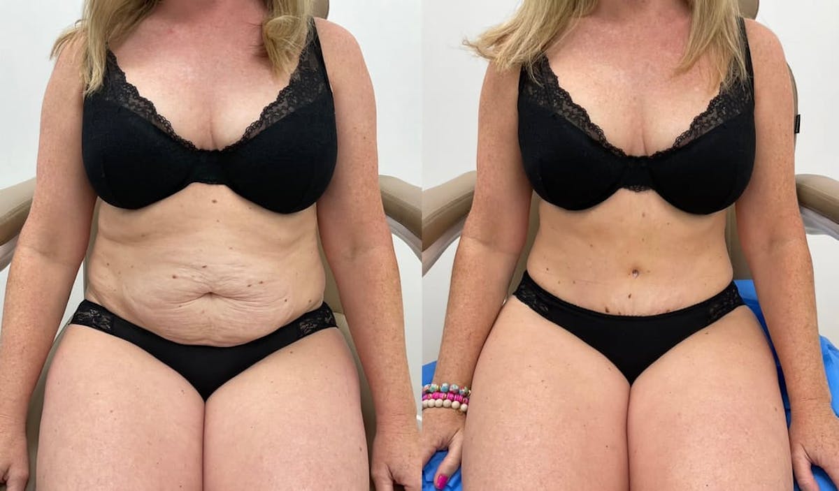 Tummy Tuck Before & After Gallery - Patient 235340 - Image 2