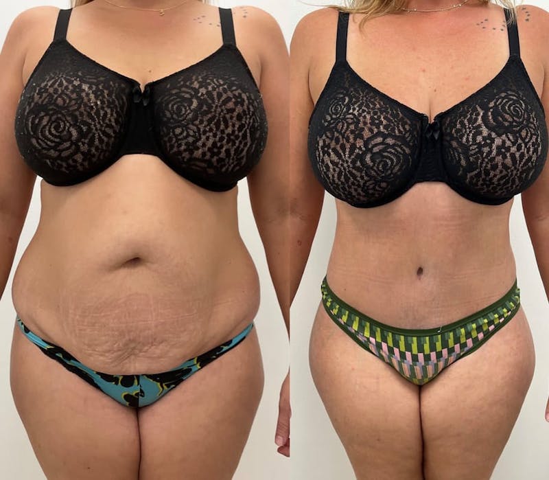 Tummy Tuck Before & After Gallery - Patient 312951 - Image 1