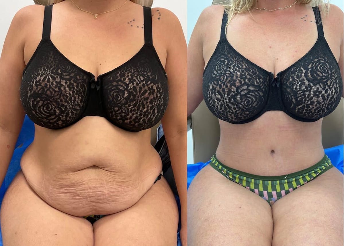 Tummy Tuck Before & After Gallery - Patient 312951 - Image 2