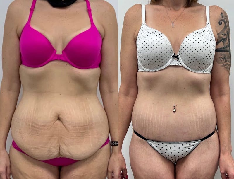 Tummy Tuck Before & After Gallery - Patient 406894 - Image 1