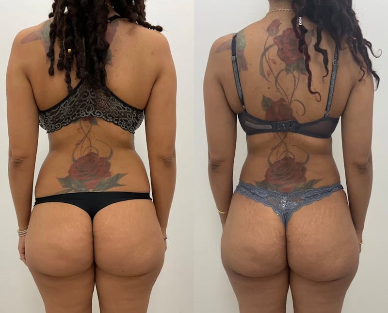 Tummy Tuck Before & After Gallery - Patient 253877 - Image 1