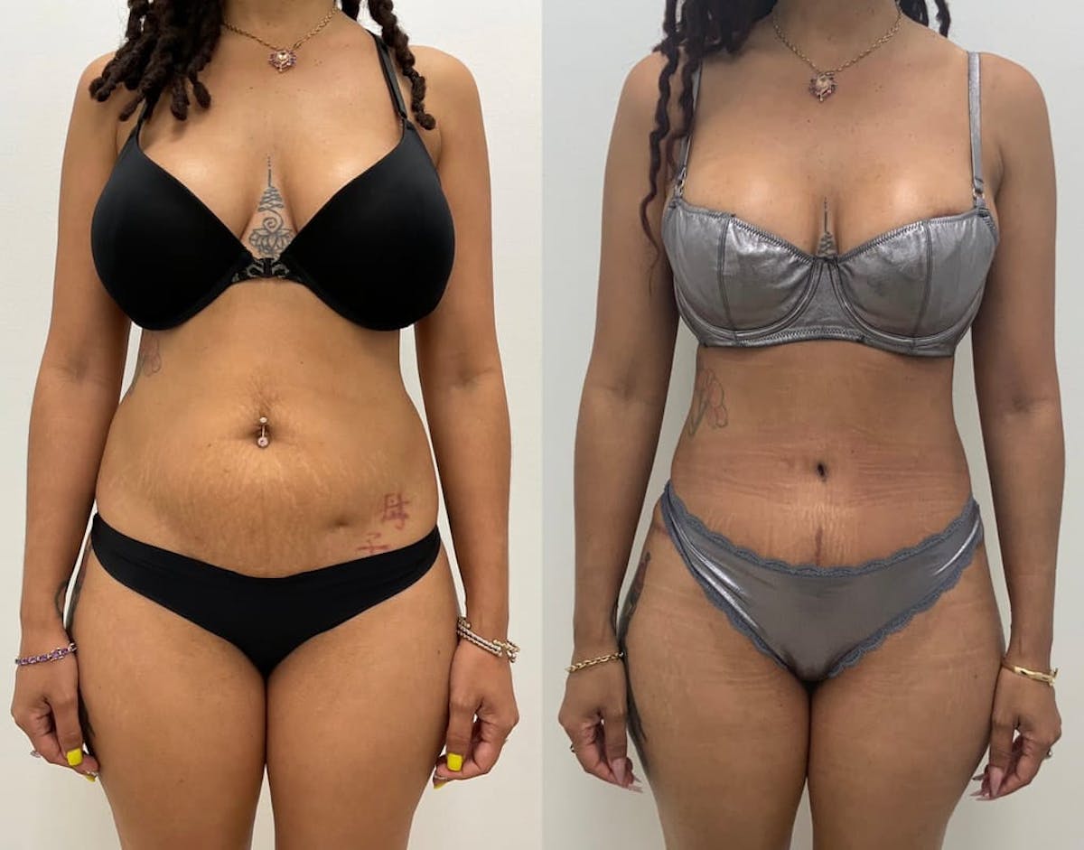 Tummy Tuck Before & After Gallery - Patient 253877 - Image 2