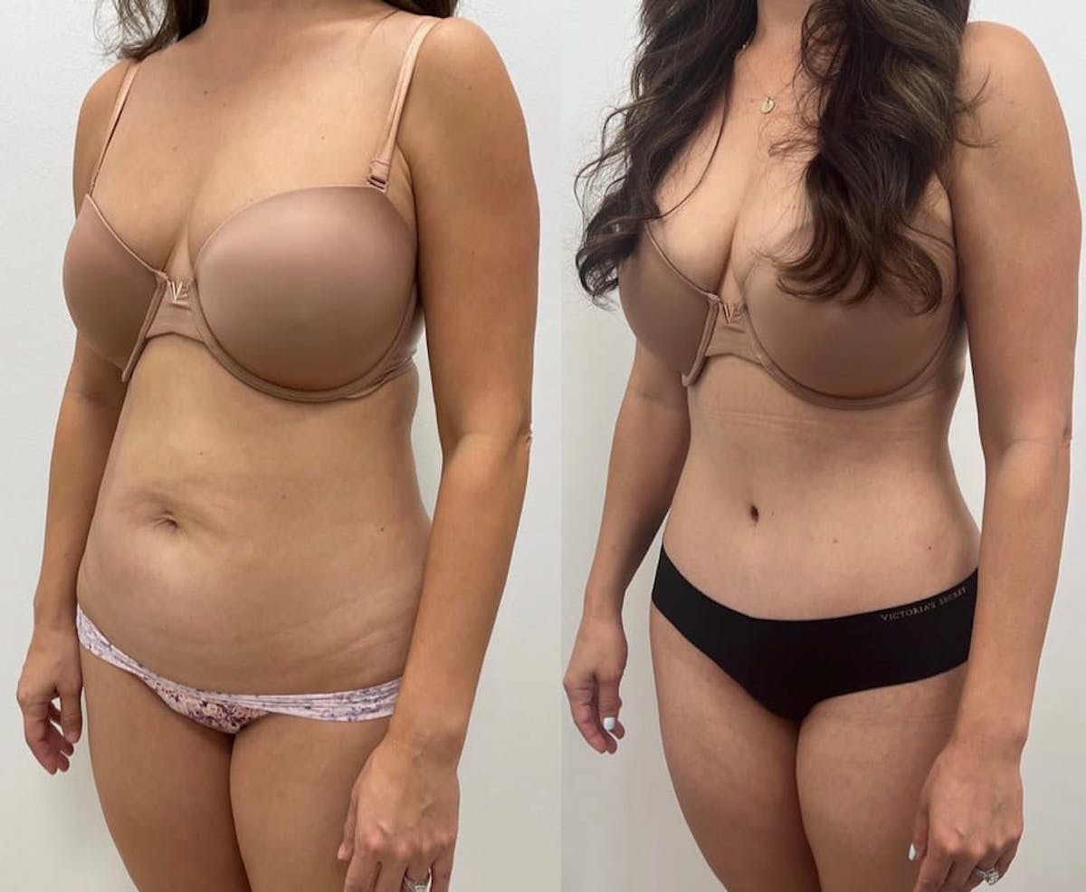 Tummy Tuck Before & After Gallery - Patient 368053 - Image 1