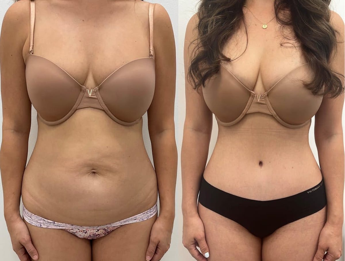 Tummy Tuck Before & After Gallery - Patient 368053 - Image 2