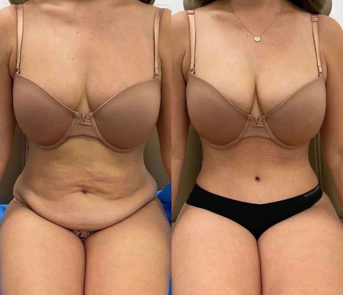 Tummy Tuck Before & After Gallery - Patient 368053 - Image 3