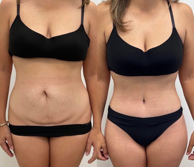 Tummy Tuck Before & After Gallery - Patient 368490 - Image 1