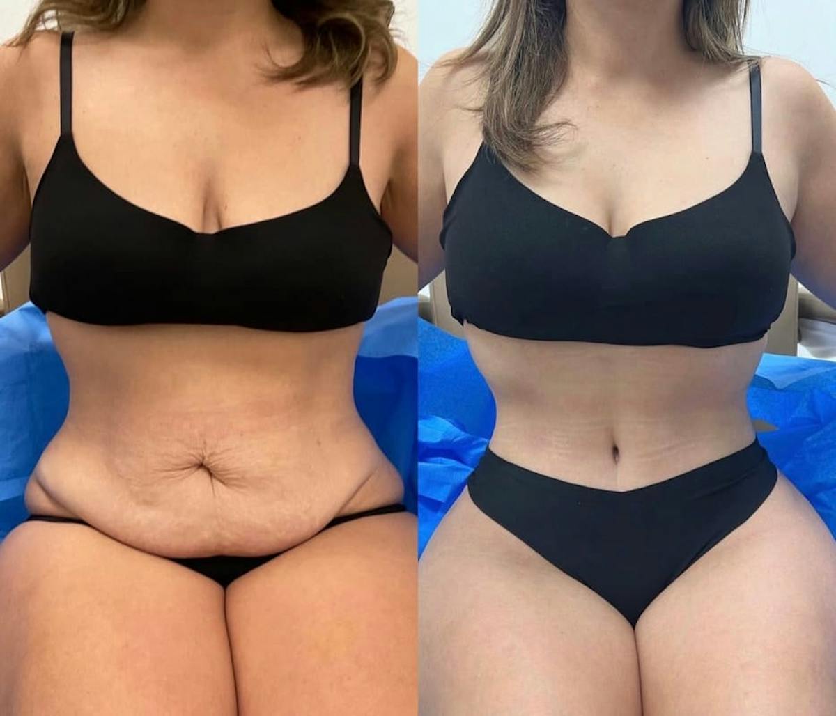 Tummy Tuck Before & After Gallery - Patient 368490 - Image 2