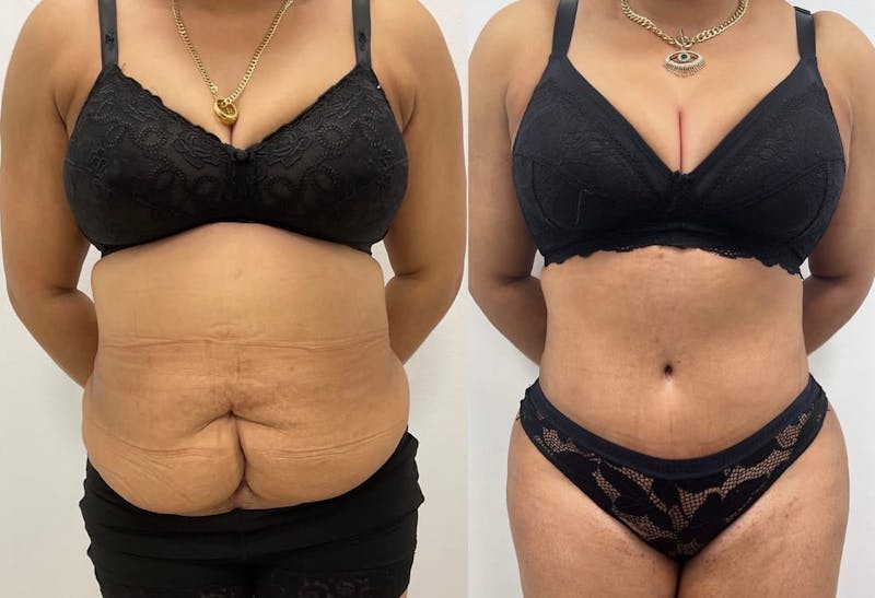 Tummy Tuck Before & After Gallery - Patient 120507 - Image 1