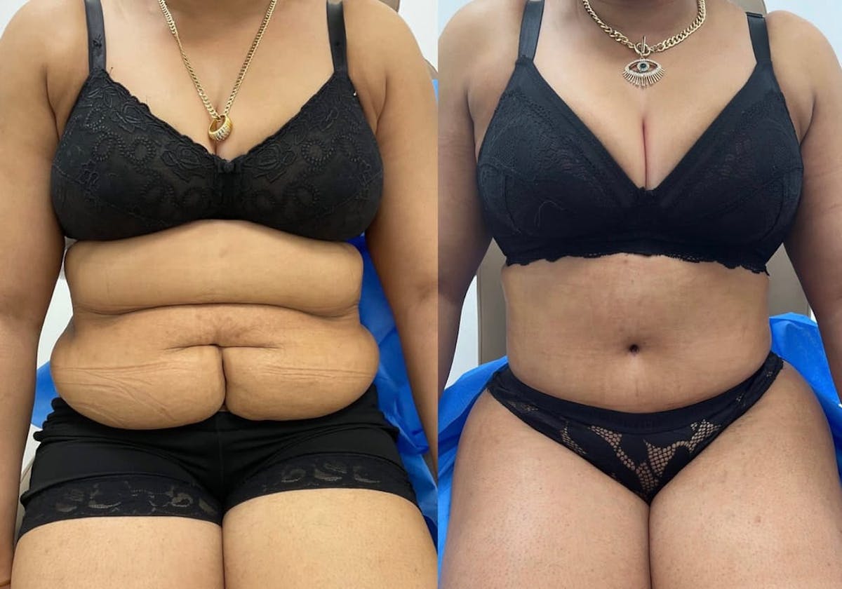 Tummy Tuck Before & After Gallery - Patient 120507 - Image 2