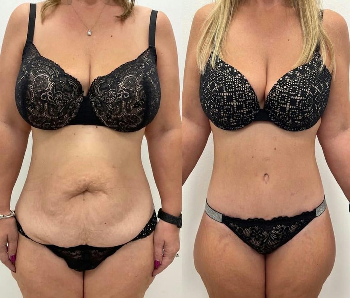 Tummy Tuck Before & After Gallery - Patient 484508 - Image 1