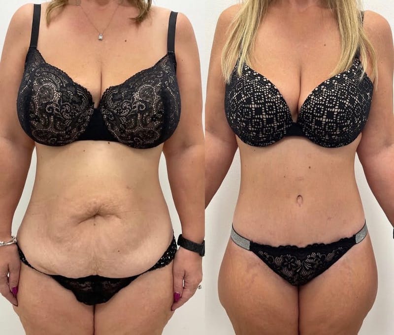Tummy Tuck Before & After Gallery - Patient 484508 - Image 1