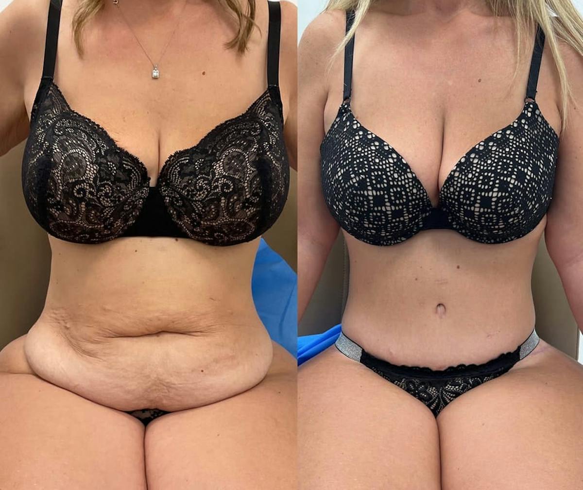 Tummy Tuck Before & After Gallery - Patient 484508 - Image 2