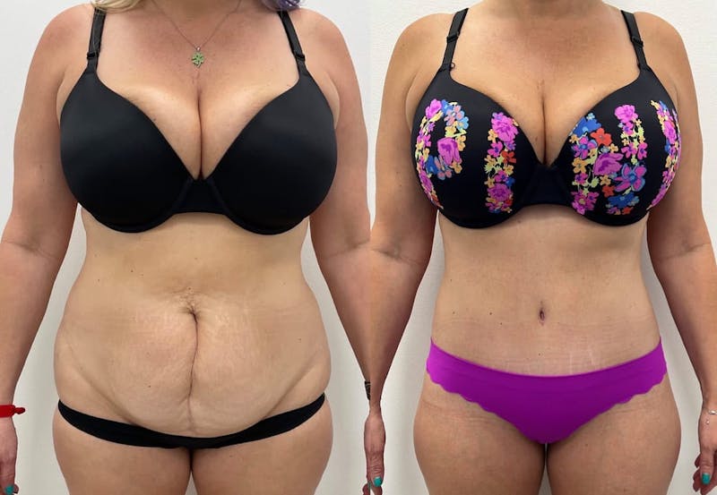 Tummy Tuck Before & After Gallery - Patient 344891 - Image 1