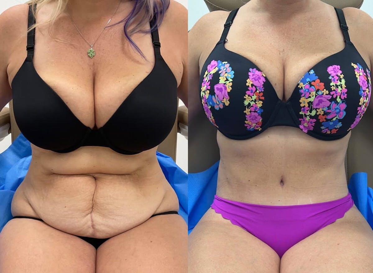 Tummy Tuck Before & After Gallery - Patient 344891 - Image 2