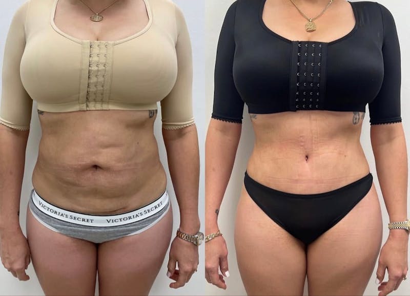 Tummy Tuck Before & After Gallery - Patient 175453 - Image 1
